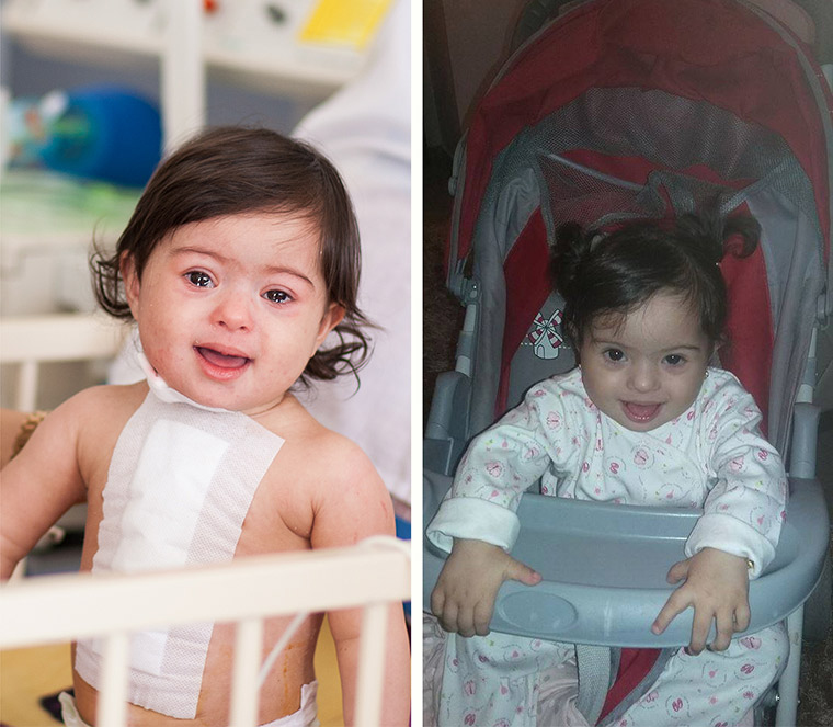 Side-by-side photos of little Malak, immediate after her lifesaving heart surgery in Libya and after she healed up and went home.