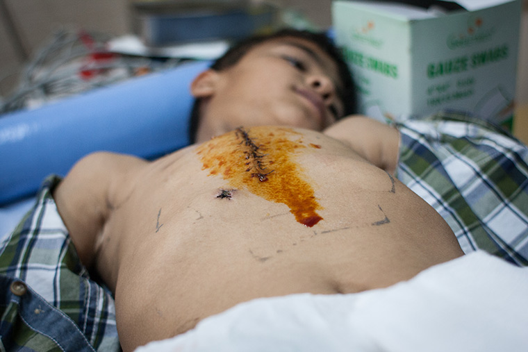 Mohammad lays on a gurney, a row of stitches down his chest from recent lifesaving heart surgery soak in iodine. Preemptive Love Coalition
